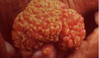 尖锐湿疣前期有哪些症状 男性湿锐尖初期图片